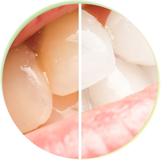 気になる歯の色を白くしませんか？