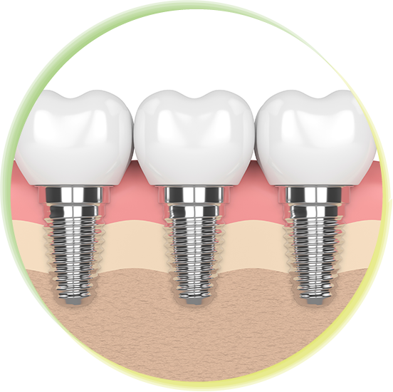 インプラント治療で失った歯の機能を回復しませんか？