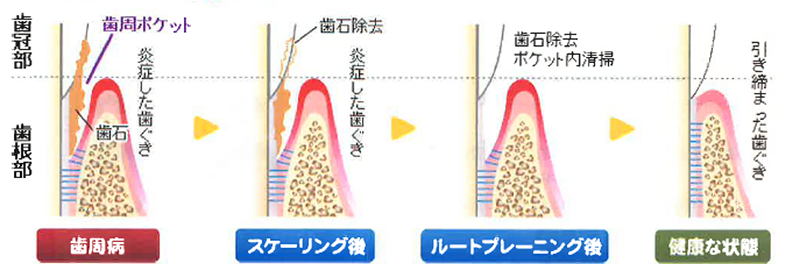 歯周病治療で行うSRPとは