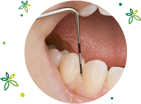 STEP3：歯周病再検査、SRP