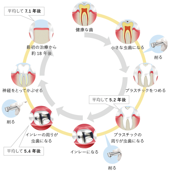 歯を失うまでの流れ